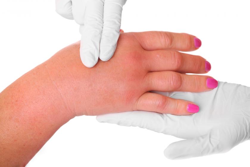 โรคแองจีโออีดีมา (Angioedema)