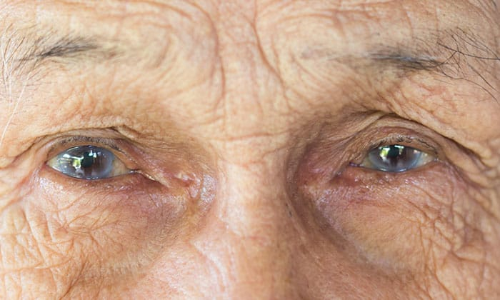 ตามืดบอดเฉียบพลัน อาจเป็นเพราะ เส้นเลือดจอประสาทตาอุดตัน ก็ได้นะ