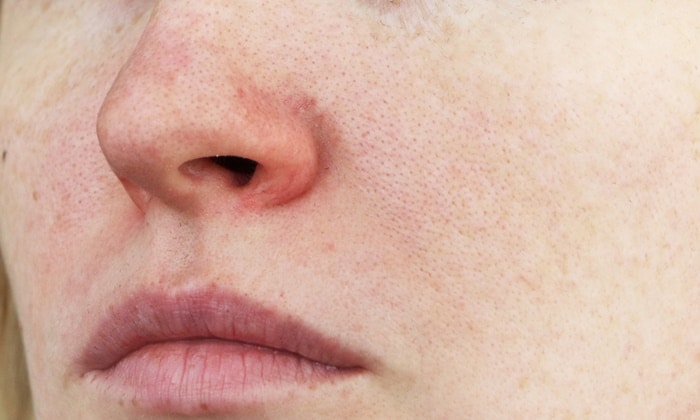 จมูกอักเสบจากภูมิแพ้ (Allergic Rhintis)