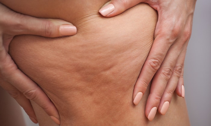 เซลลูไลท์ (Cellulite)