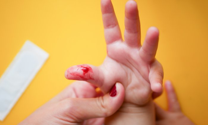 ของมีคม ลูกโดนมีดบาดดูแลยังไงไม่ให้เป็นแผลเป็น