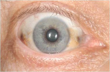 แอลแคปโตนูเรีย (Alkaptonuria)