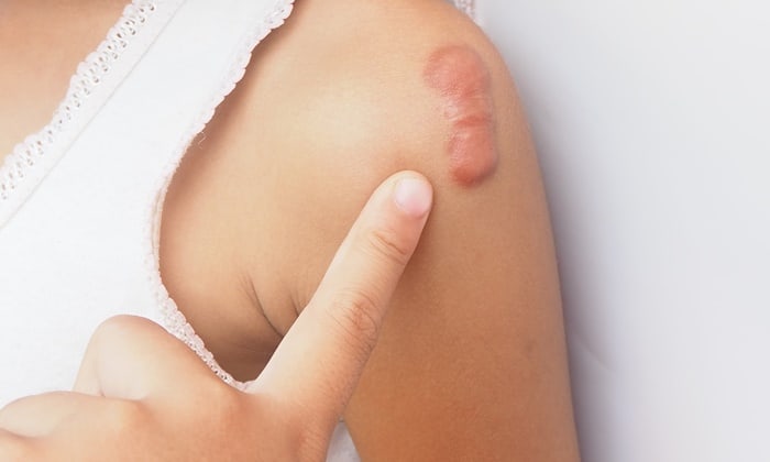 แผลเป็น เด็ก จะรักษาได้อย่างไร