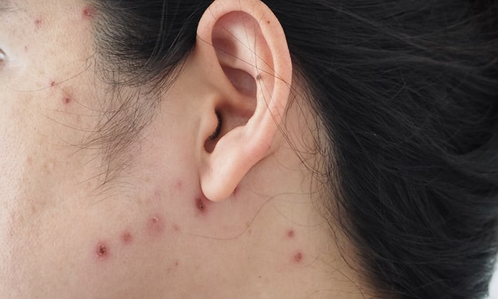 อาการติดเชื้อบนผิวหนัง ที่มักพบในผู้ป่วยโรคเอดส์ มีอะไรบ้าง