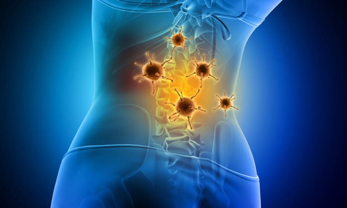 Bone Metastasis มะเร็งลามมากระดูก สาเหตุ อาการ และการรักษา