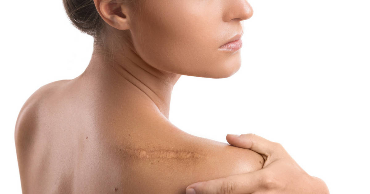 แผลเป็น และวิธีลดรอยแผลเป็น