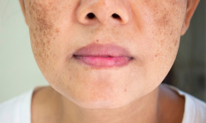 อาร์บูติน คืออะไร ช่วยดูแลปัญหาผิวได้หรือไม่