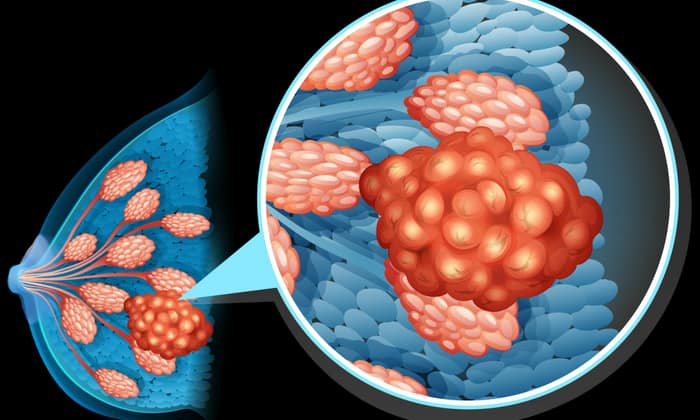 ไขข้อสงสัยเกี่ยวกับ มะเร็งเต้านมอักเสบ (Inflammatory Breast Cancer)