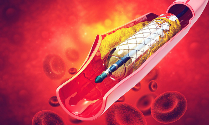 ขดลวดตาข่าย รักษาโรคหัวใจ กับสิ่งที่คุณควรรู้