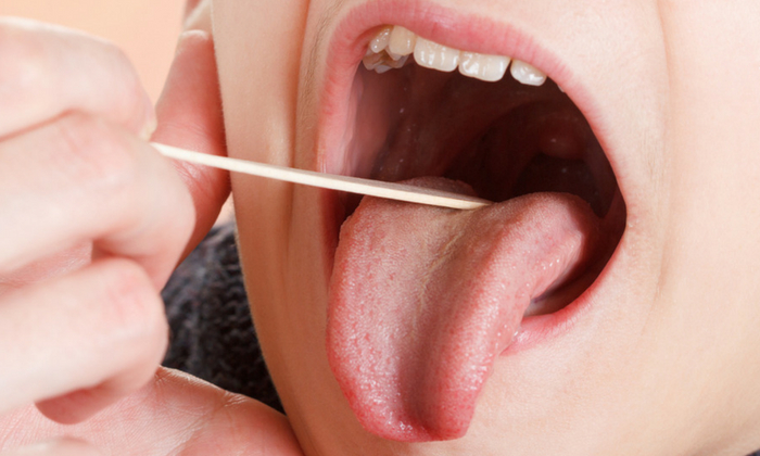 ต่อมทอนซิลอักเสบเรื้อรัง (Chronic Tonsillitis)