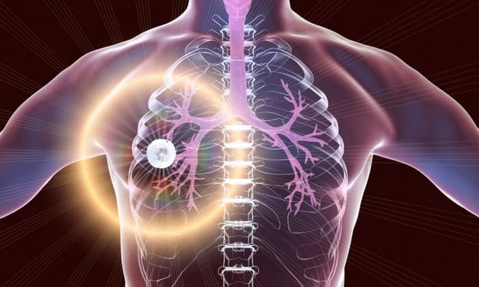 วัณโรคปอด (Pulmonary Tuberculosis)