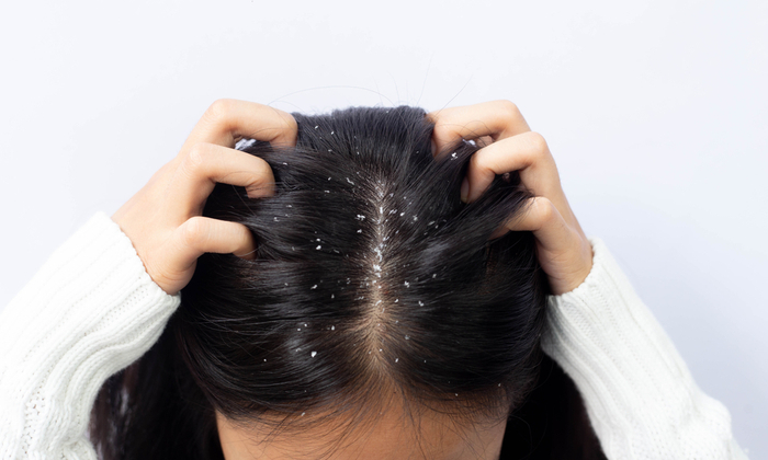 สาเหตุและวิธีการรักษา รังแค