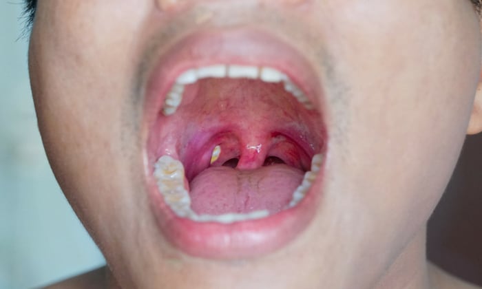 ต่อมทอนซิลโต (Tonsillar Hypertrophy)