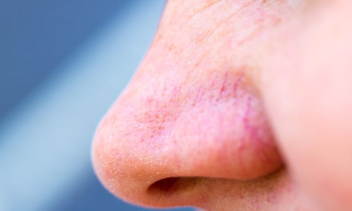 ไซนัสอักเสบเฉียบพลัน (Acute Sinusitis)