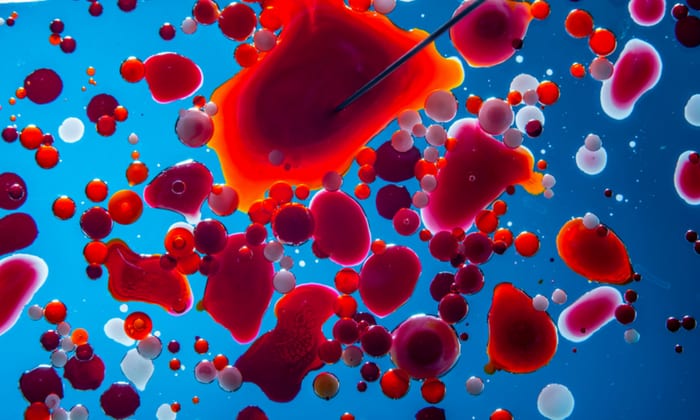 ภาวะขาดเอนไซม์G6PD (G6PD Deficiency)