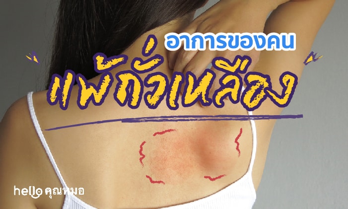 ภูมิแพ้ถั่วเหลือง (Soy Allergy)