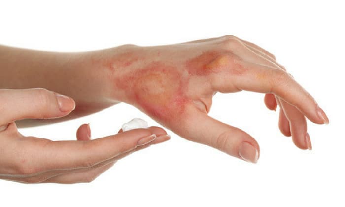 แผลไฟไหม้ น้ำร้อนลวก การดูแลตัวเองที่บ้านอย่างถูกวิธี