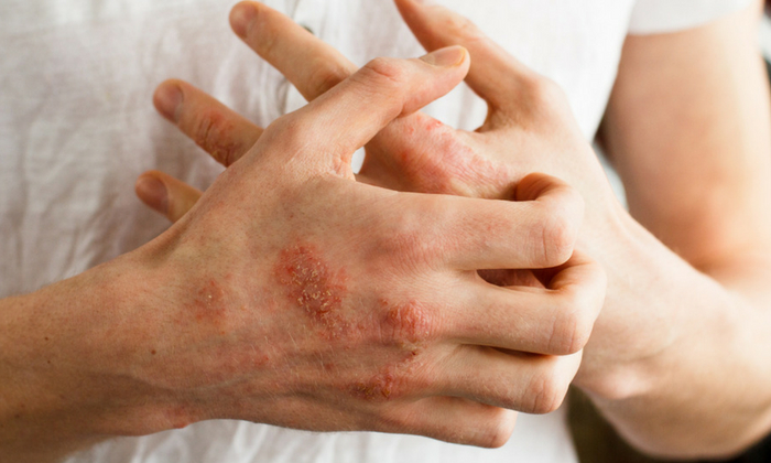 ปัญหาผิวจากเชื้อเอชไอวี เกิดขึ้นเพราะอะไร และรักษาได้อย่างไรบ้าง