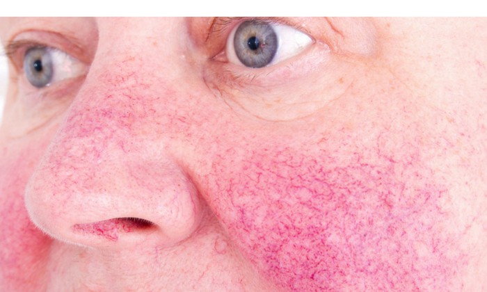 โรซาเซียที่ดวงตา (Ocular Rosacea)