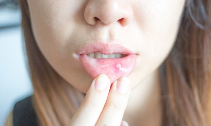 แผลร้อนใน (Canker Sores)