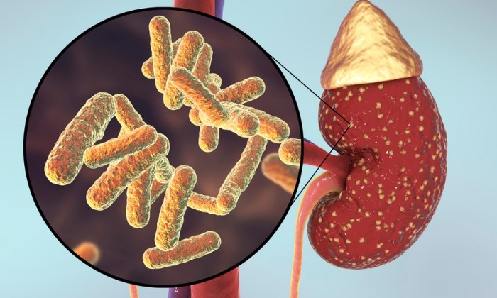 กรวยไตอักเสบ (Pyelonephritis)