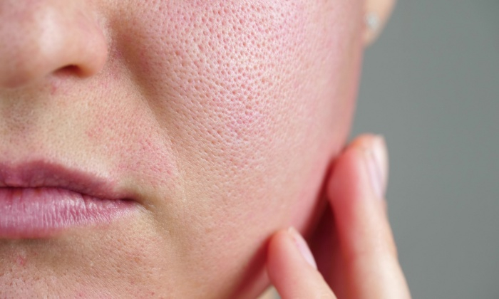 ผิวหนังอักเสบภูมิแพ้ อาการ สาเหตุ และการรักษา