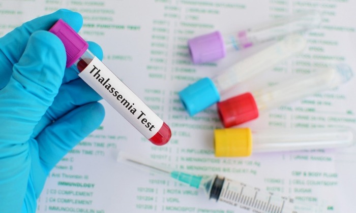 ธาลัสซีเมีย อาการ สาเหตุ การรักษา