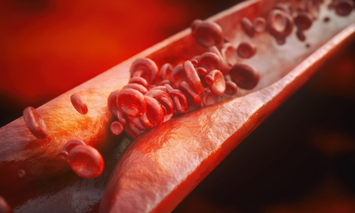 หลอดเลือดแดงแข็ง (Atherosclerosis)