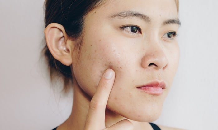 รอยสิว มีสาเหตุจากอะไรบ้าง