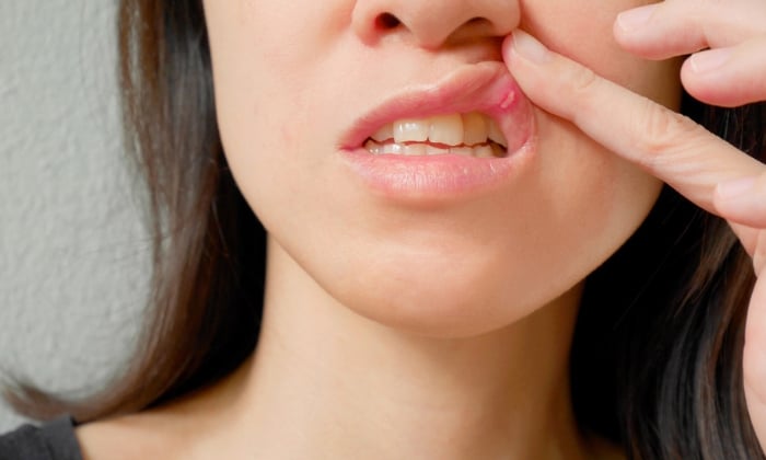 แผลร้อนในในช่องปาก อาการเจ็บปวดที่พบบ่อย จัดการยังไงได้บ้าง