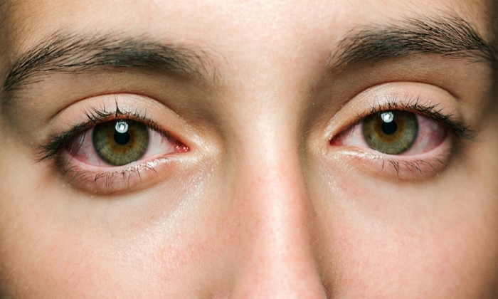 โรคคอพอกตาโปน โรคตาที่เกิดจากความผิดปกติของต่อมไทรอยด์