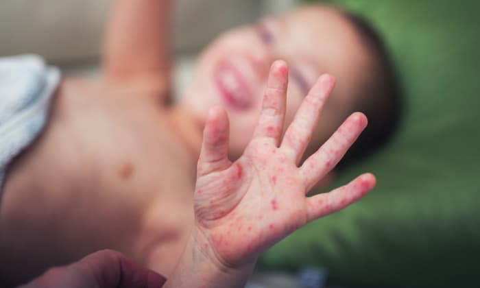 โรคมือเท้าปาก สามารถลดความเสี่ยงในการเกิดได้อย่างไร