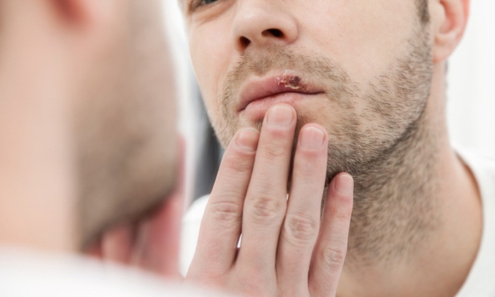 โรคเริมที่ปาก เกิดจากอะไรและดูแลได้อย่างไรเมื่ออาการกำเริบ