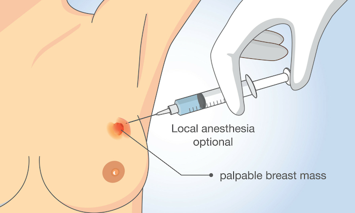 ตัดชิ้นเนื้อเต้านมส่งตรวจ (Breast Biopsy)