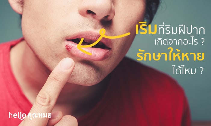 เริมที่ริมฝีปาก (Cold Sore)