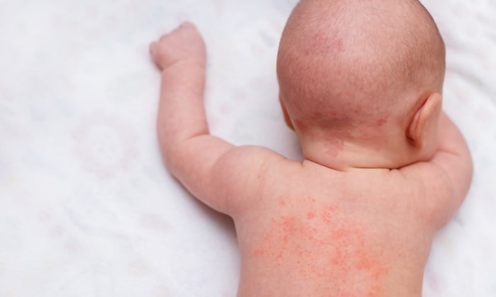 ุ6 ปัญหาผิวลูก ที่พบบ่อย มีอะไรบ้าง