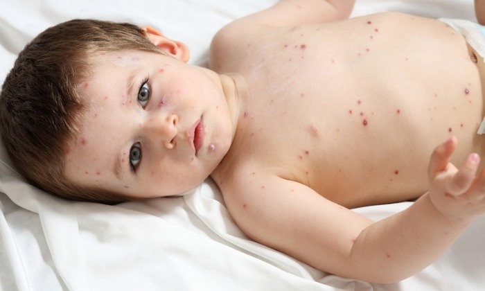 อีสุกอีใส ใน เด็ก มีวิธีการดูแลอย่างไรบ้าง