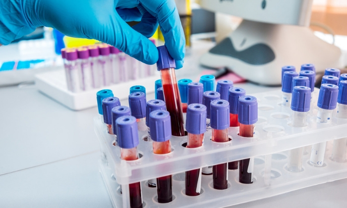 ทดสอบกดการทำงานของโคลนิดีน (Clonidine Suppression Test)