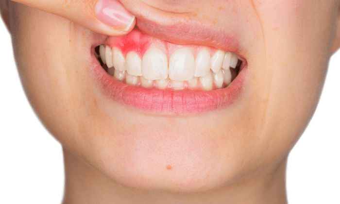 โรคเหงือกกับความดันโลหิตสูง เกี่ยวข้องกันอย่างไร