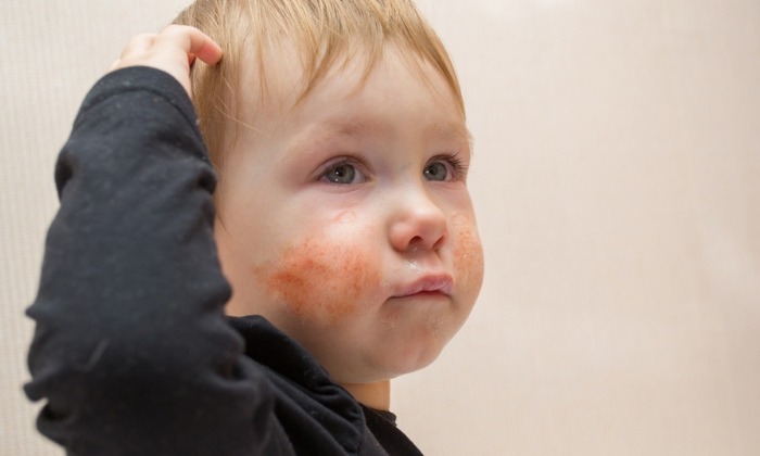 ผื่นภูมิแพ้ผิวหนัง (Atopic Eczema)