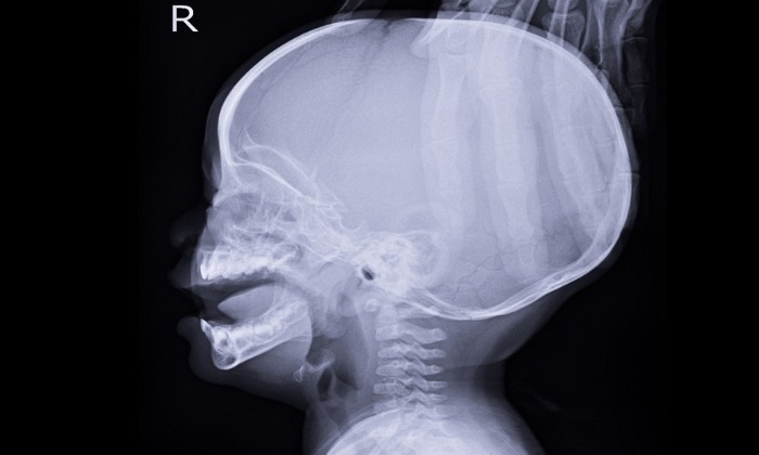 โพรงสมองคั่งน้ำ (Hydrocephalus)