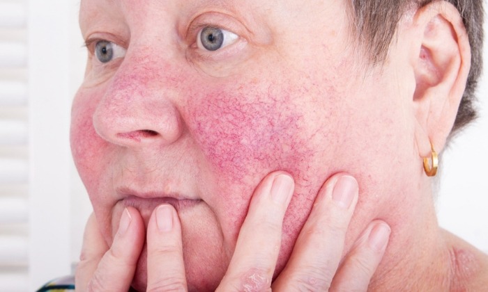 โรซาเซีย อาการ สาเหตุ และการรักษา