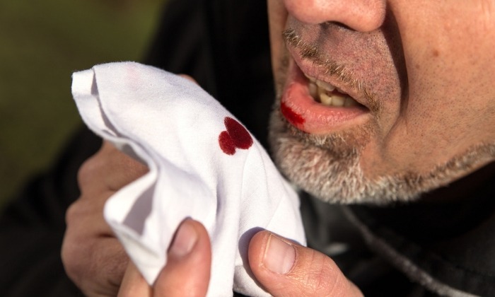 ไอเป็นเลือด (Coughing blood)