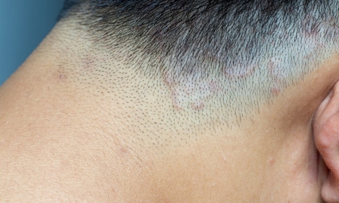 กลากที่หนังศีรษะ สาเหตุ อาการ และวิธีรักษา