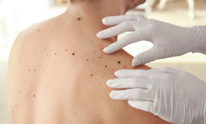 มะเร็งผิวหนังเมลาโนมา (Melanoma)