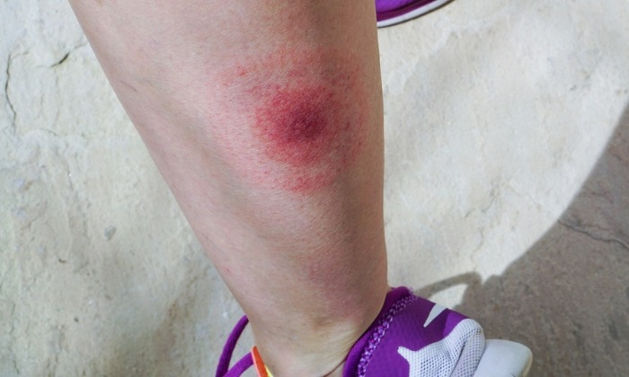 โรคลายม์ (Lyme Disease)