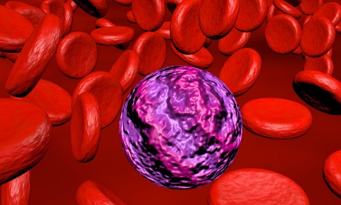 มะเร็งเม็ดเลือดขาวเฉียบพลันชนิดมัยอิลอยด์ (Acute Myeloid Leukemia)