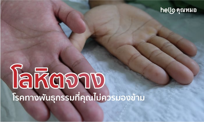 โลหิตจางจากปัจจัยทางพันธุกรรม ที่ควรรู้จักมีอะไรบ้าง?