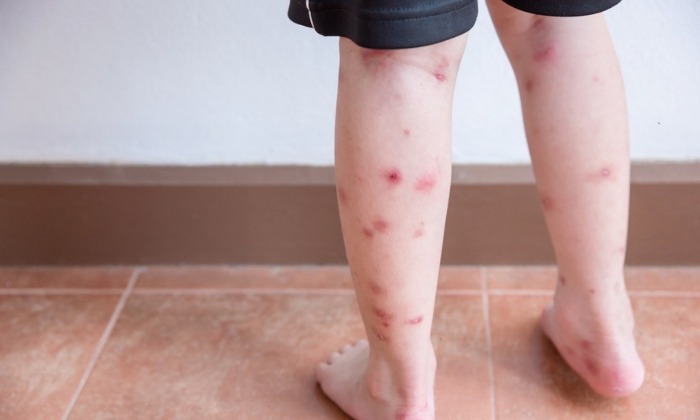 แพ้ยุง อาการ วิธีบรรเทา และวิธีป้องกัน