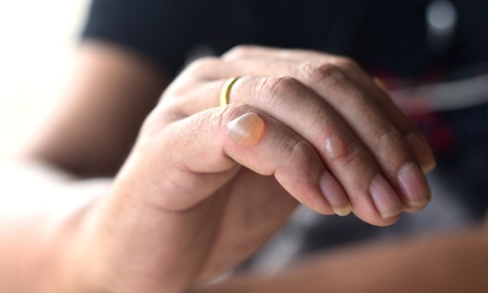 ตุ่มพอง จากการเสียดสี รองเท้ากัด หรือน้ำร้อนลวก ควรเจาะดีหรือเปล่า?